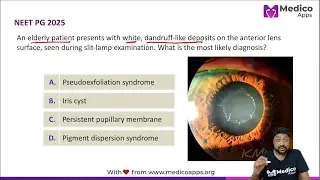 High Yield for NEET PG 2025 🎯|👁️ Pseudoexfoliation Syndrome | Dr. Abhishek Gupta | Ophthalmology