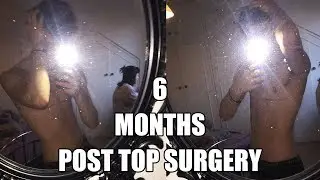 6 Months Post Op // FtM Top Surgery with Dr Garramone