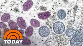 California, Illinois Declare Monkeypox Health Emergencies