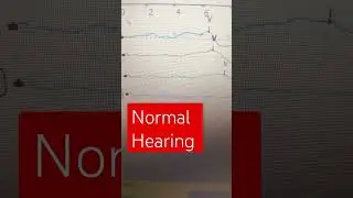 Hearing evaluation|| bera test for baby hindi