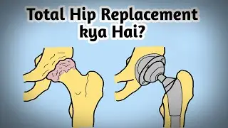 Is kaaran ki zaati hai hip replacement surgery in hindi & english  #hipfracture  #hiparthritis