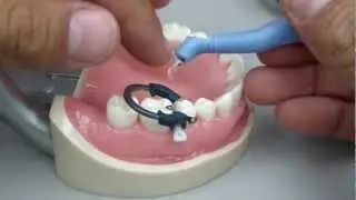 Class II Composite - Proximal Contact Development