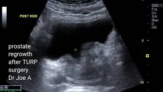 Prostatomegaly recurring 10 years after resection of prostate by TURP surgery- ultrasound video