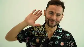 Пересадка волос Ильшата Шабаева в Turkey Hair Academy