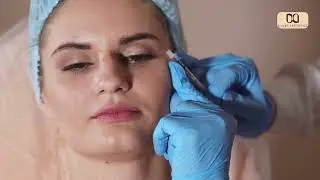Botox for Frown Lines in Dallas, TX | Quick & Effective Treatment