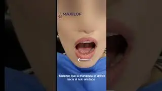 Tu mandibula se va de lado #shorts #Maxillofacial #Dentist #dentista