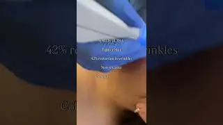 EXILIS Ultra non-invasive skin tightening