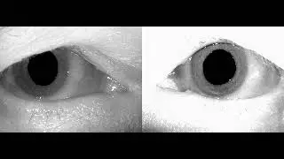 L Spontaneous nystagmus, subacute RIGHT vestibulopathy