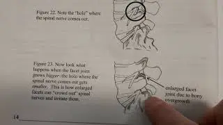 How facet joints in your back cause lateral foraminal spinal stenosis.