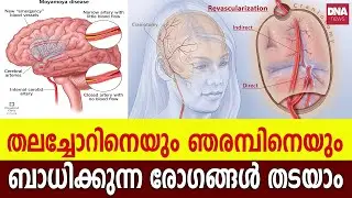 നാഡീവ്യവസ്ഥയെ ബാധിക്കുന്ന രോഗങ്ങൾ  | dnanewsmalayalam