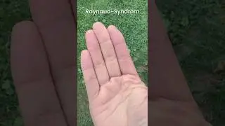 Kalte Finger? Raynaud Syndrom? Beheizbare Handschuhe! GoKozy #gloves #heated