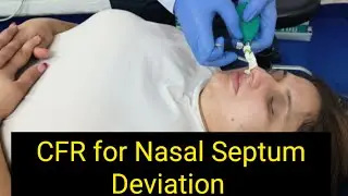 Краниально-лицевой релиз для коррекции искривления носовой перегородки #cfr #краниально-лицевойре...