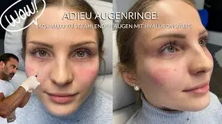 Augenringe Behandlung mit Hyaluronsaure