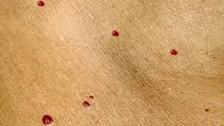 Sind diese roten Punkte auf der Haut gef&auml;hrlich? Das solltest du dar&uuml;ber wissen!