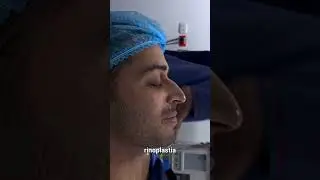 Resultados de rinoplastia minutos despu&eacute;s de cirug&iacute;a   #cirugiadenariz #antesydespues