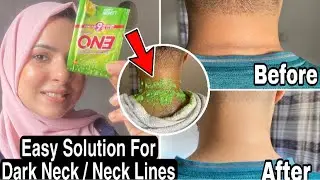 How To Lighten And Get Rid Of Dark, Discolored Neck & Neck Lines | Live Result In 15 Min 100% works