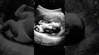 Baby Ultrasound Scan | Realistic Pregnancy Ultrasound Video | Newborn Fetus #pregnancy #shorts