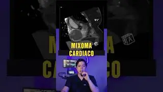 TUMOR CARDIACO MIXOMA #cardiologia #cardiology #medicine #Heart #corazon