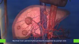 SIR-Spheres&reg; microspheres Mode of Action video