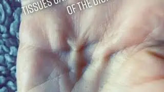 Therapist challenge Part 2 (Dupuytrens)