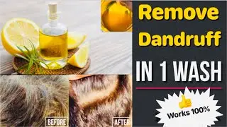 1 WASH CHALLENGE: Remove Dandruff in Just 1 Wash  | Dandruff Treatment at Home | Preity प्रेरणा