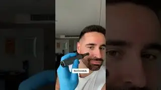 Microneedling with the M8s