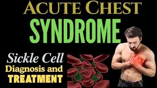 Understanding Acute Chest Syndrome: A Sickle Cell Complication