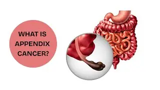 📹 What Is Appendix Cancer? Spot Cancer Early