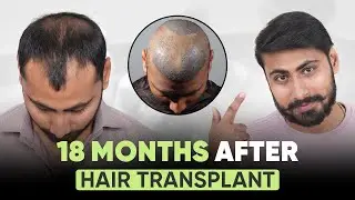 Hair Transplant in Gurgaon (HX-FOOY) | Best Results & Cost of Hair Transplant in Gurgaon.