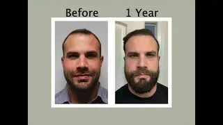 Natural Transplants Palm Beach | Remarkable Hair Transplant Results 1 Year After Hair Surgery.