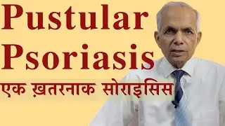 Pustular psoriasis ( pus psoriasis) ; सोराइसिस में पस के दाने #psoriasis