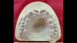 Age determination of Mixed Dentition cast