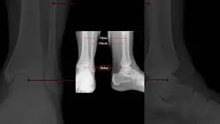 🦴 Understanding the Talus Bone | Key to Ankle Stability! #anatomy #physiotherapy #ATC #podiatry