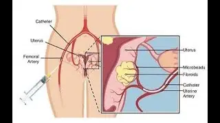 Bilateral uterine artery embolization; occlusion of both uterine arteries using embolic agents
