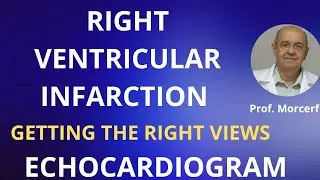 Hidden Fact: Right Ventricular Infarction Frequency Exposed