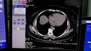 Monitoramento na Tomografia de Abdome (Curso Tomografia 2.0)