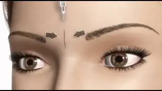 Thermage - Rejuvenecimiento facial: Arrugas entrecejo