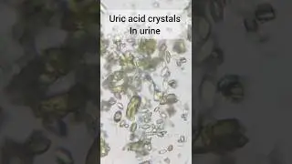 Uric acid crystals in urine #labtechnician #medicallaboratory #pathologylab #dmlt #neet