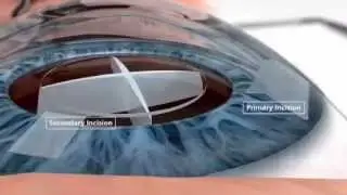 Femto-Laser | Augen-Zentrum-Nordwest