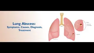 lung abscess pus filled cavity in the lung ; Definition, Causes, Symptoms, Diagnosis, Treatment