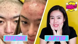 Cerita Perjuangan Ku Melawan Jerawat! Akhirnya Berhasil