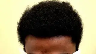Black Man Hair Transplant 2 Year Follow Up with Before and After Dr. Diep www.mhtaclinic.com