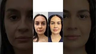 Doctor Made Her Look HOT 😍 24 Year Old Gets Plastic Surgery!