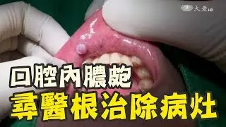 嘴巴一直破 查查是否黏液囊腫