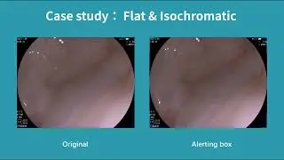 Real-Time Polyp Detection AI For Flat & Isochromatic Cases
