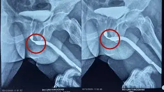 Uttarbasti for Urethral Stricture | Ayurvedic Solution for Urine Blockage #urethralstricture 