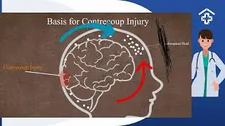 Coup and contrcoup explained in a minute!