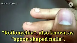 Koilonychia | Spoon Shaped nails Classical Example | Dr. Dinesh Solunke #shorts