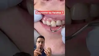 Facette ou couronne : quelle diff&eacute;rence, et laquelle choisir ?