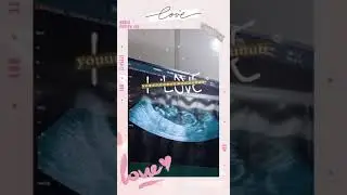 MCDA twin 17weeks